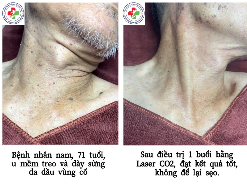 ĐIỀU TRỊ U MỀM TREO VÀ DÀY SỪNG DA ĐẦU BẰNG TIA LASER TẠI TTYT KHU VỰC PHÙ NINH