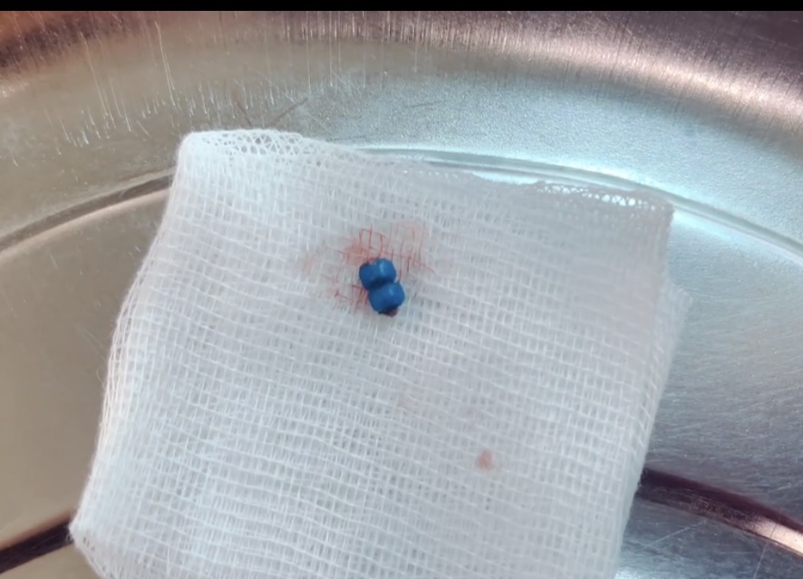 Viên đạn súng đồ chơi trong tai bệnh nhi