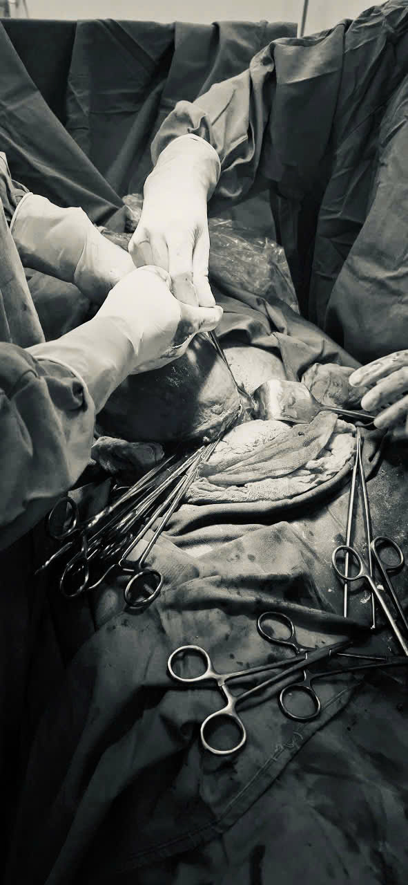 PT cắt TC bán phần 3