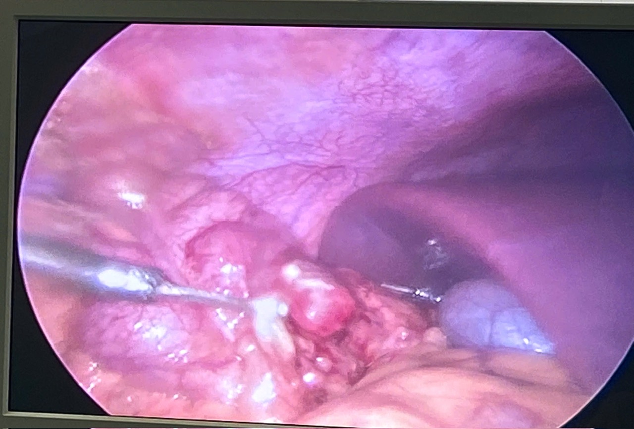 Ruột thừa dưới gan 2