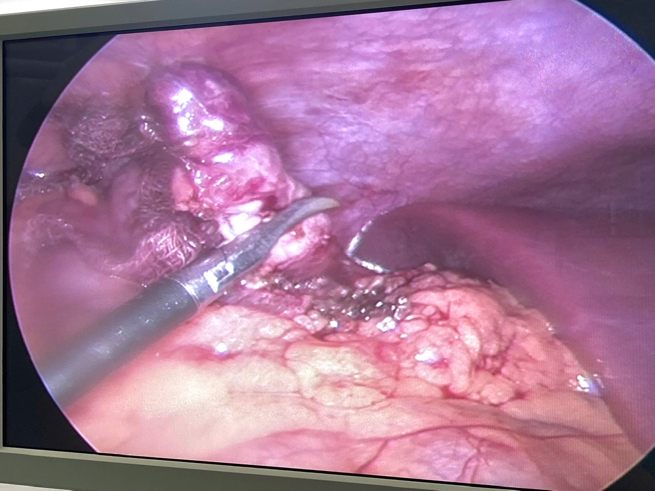 Ruột thừa dưới gan 3